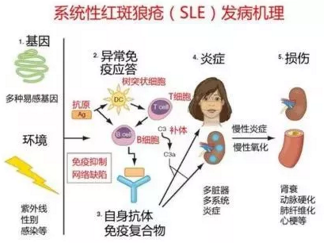 系統(tǒng)性紅斑狼瘡，干細胞治療有效嗎？