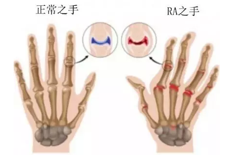 干細(xì)胞治療類(lèi)風(fēng)濕性關(guān)節(jié)炎：改善疼痛和阻斷惡