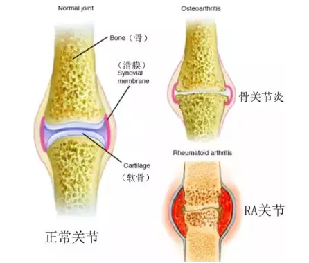 干細(xì)胞治療類(lèi)風(fēng)濕性關(guān)節(jié)炎：改善疼痛和阻斷惡