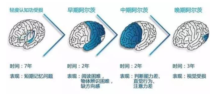 再生醫(yī)學(xué)干細(xì)胞有效治療阿爾茨海默病