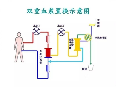 精準(zhǔn)凈化，煥活健康：DFPP雙重血漿凈化技術(shù)