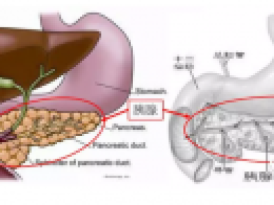 間充質干細胞是重癥胰腺炎患者的新選擇